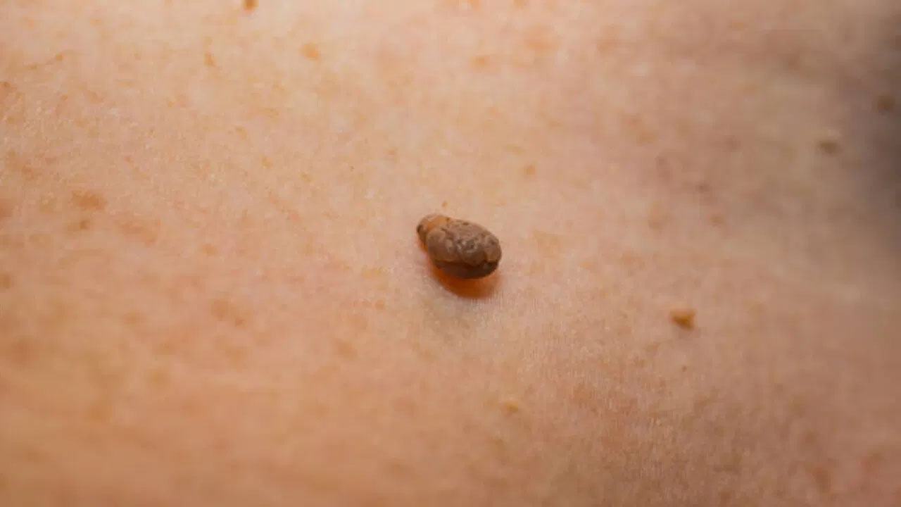 Effective Natural Home Remedies To Get Rid Of Skin Tags Safely And Quickly