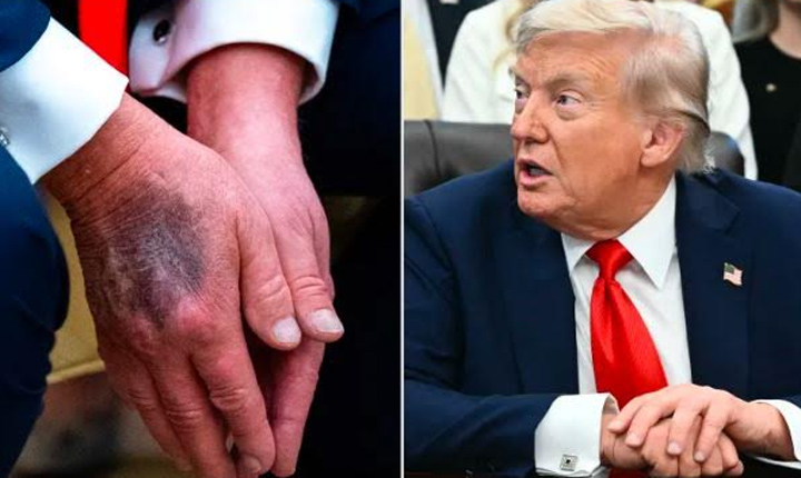 Trump Says Heavy Bruise On His Left Hand