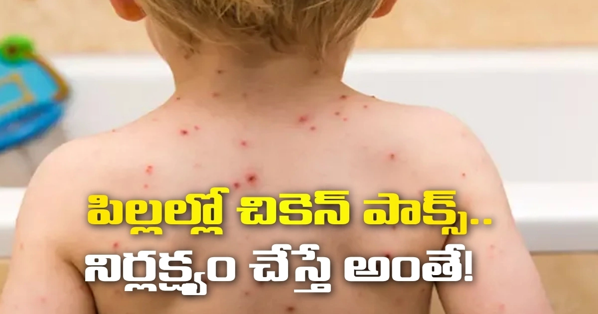 పిల్లల్లో చికెన్ పాక్స్.. నిర్లక్ష్యం చేస్తే అంతే! పిల్లల్లో చికెన్ పాక్స్.. నిర్లక్ష్యం చేస్తే అంతే!