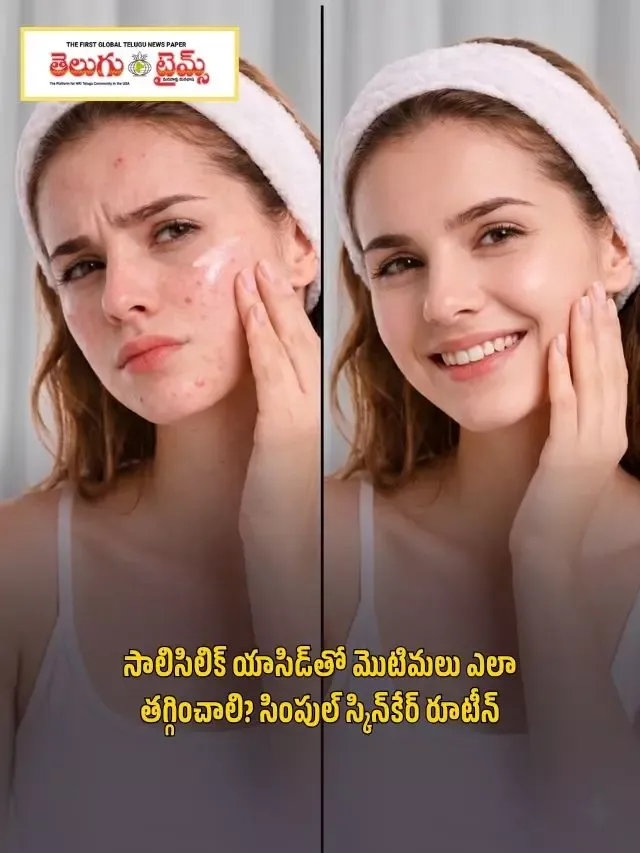 సాలిసిలిక్ యాసిడ్‌తో మొటిమలు ఎలా తగ్గించాలి? సింపుల్ స్కిన్‌కేర్ రూటీన్