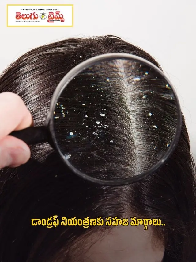 Natural Ways to Control Dandruff