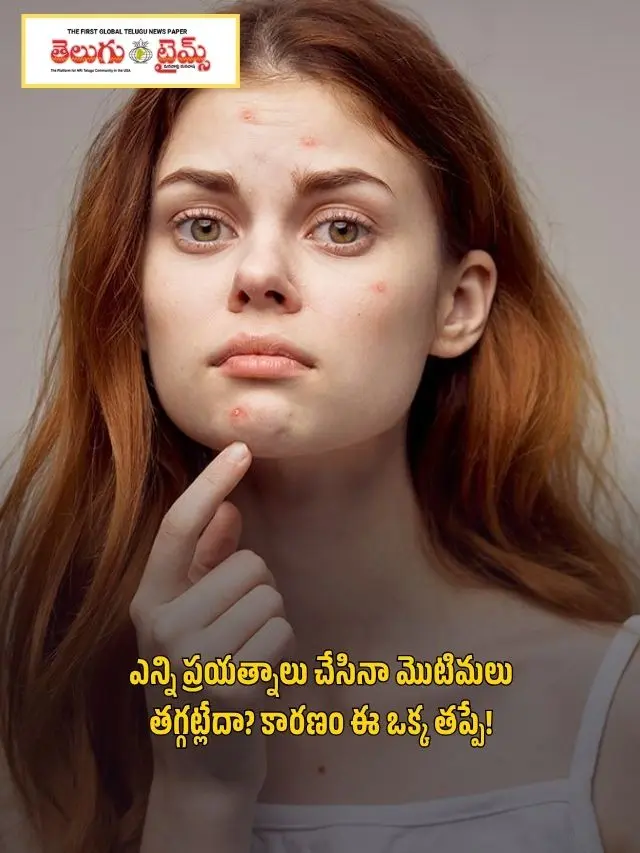 No matter how many times you try, your acne won't go away The reason is this one mistake!