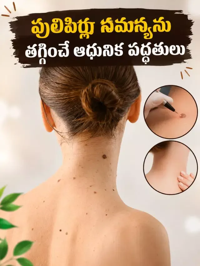 పులిపిర్లు సమస్యను తగ్గించే ఆధునిక పద్ధతులు