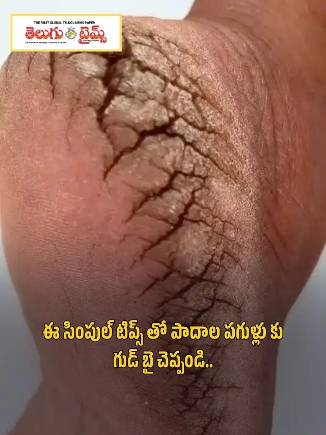 ఈ సింపుల్ టిప్స్ తో పాదాల పగుళ్లు కు గుడ్ బై చెప్పండి..