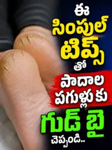 cracked foot