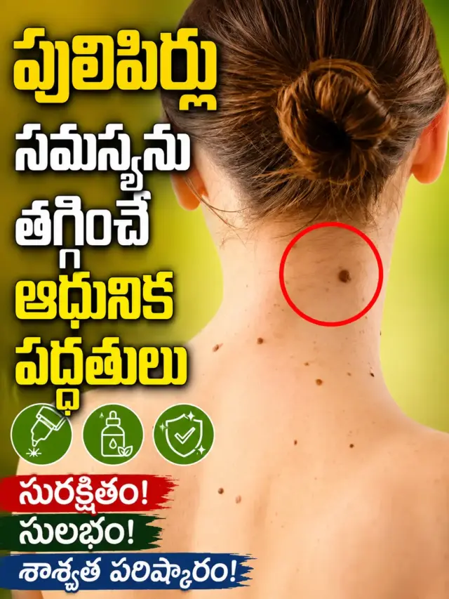 పులిపిర్లు సమస్యను తగ్గించే ఆధునిక పద్ధతులు