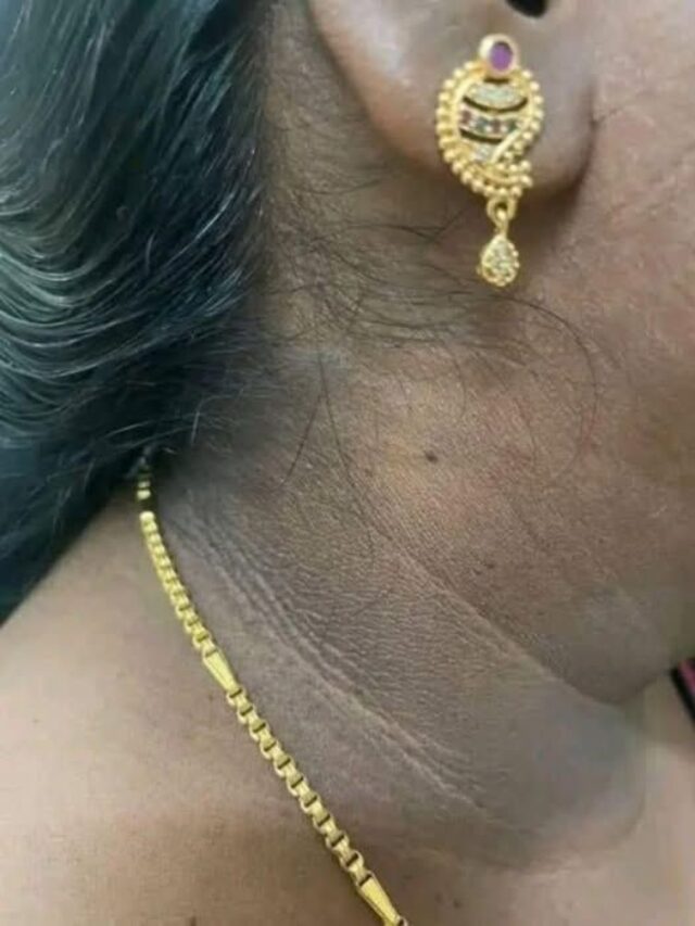 మెడ చుట్టూ నలుపు ఎందుకు వస్తుంది? ఈ  కారణాలు తెలుసుకోండి