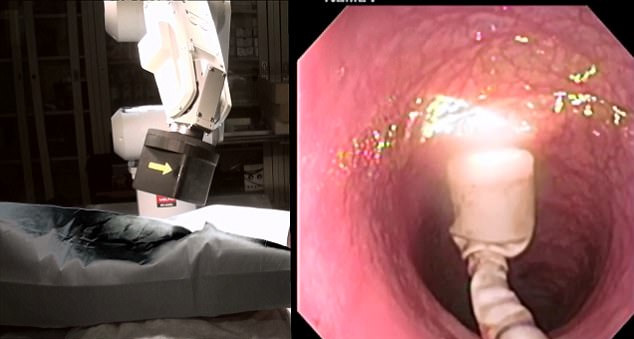 రోబో మాత్రతో కొలనోస్కోపీ