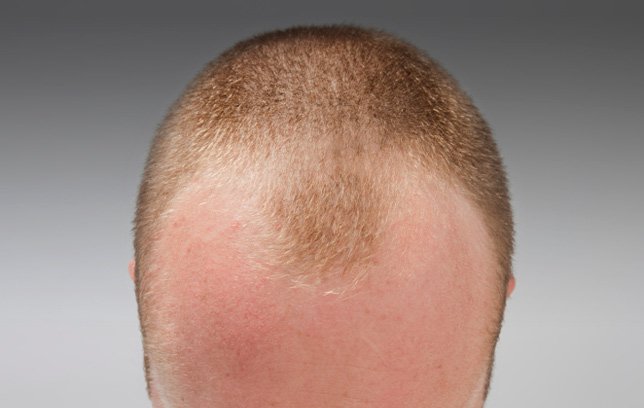 బట్టతలకు…. మరో కొత్త కారణం