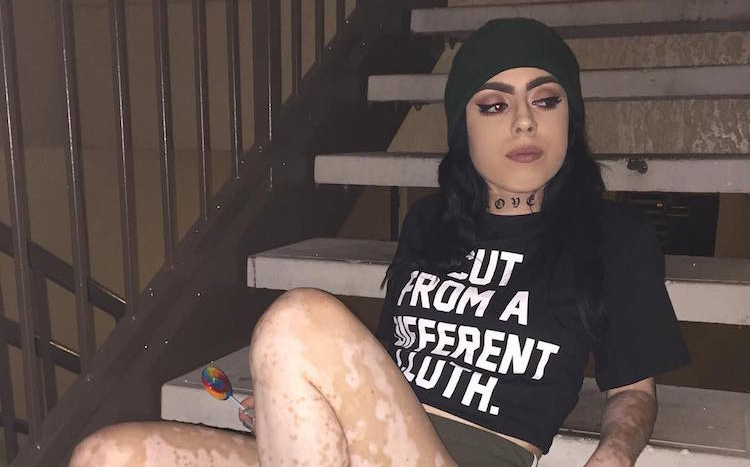 This Ah Mazing Woman Turned Her Vitiligo Into Art 