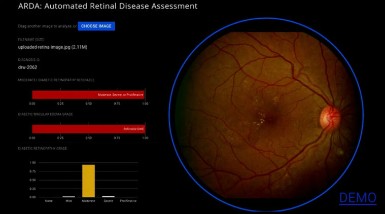 రెటీనాతో హృద్రోగాల గుర్తింపు!